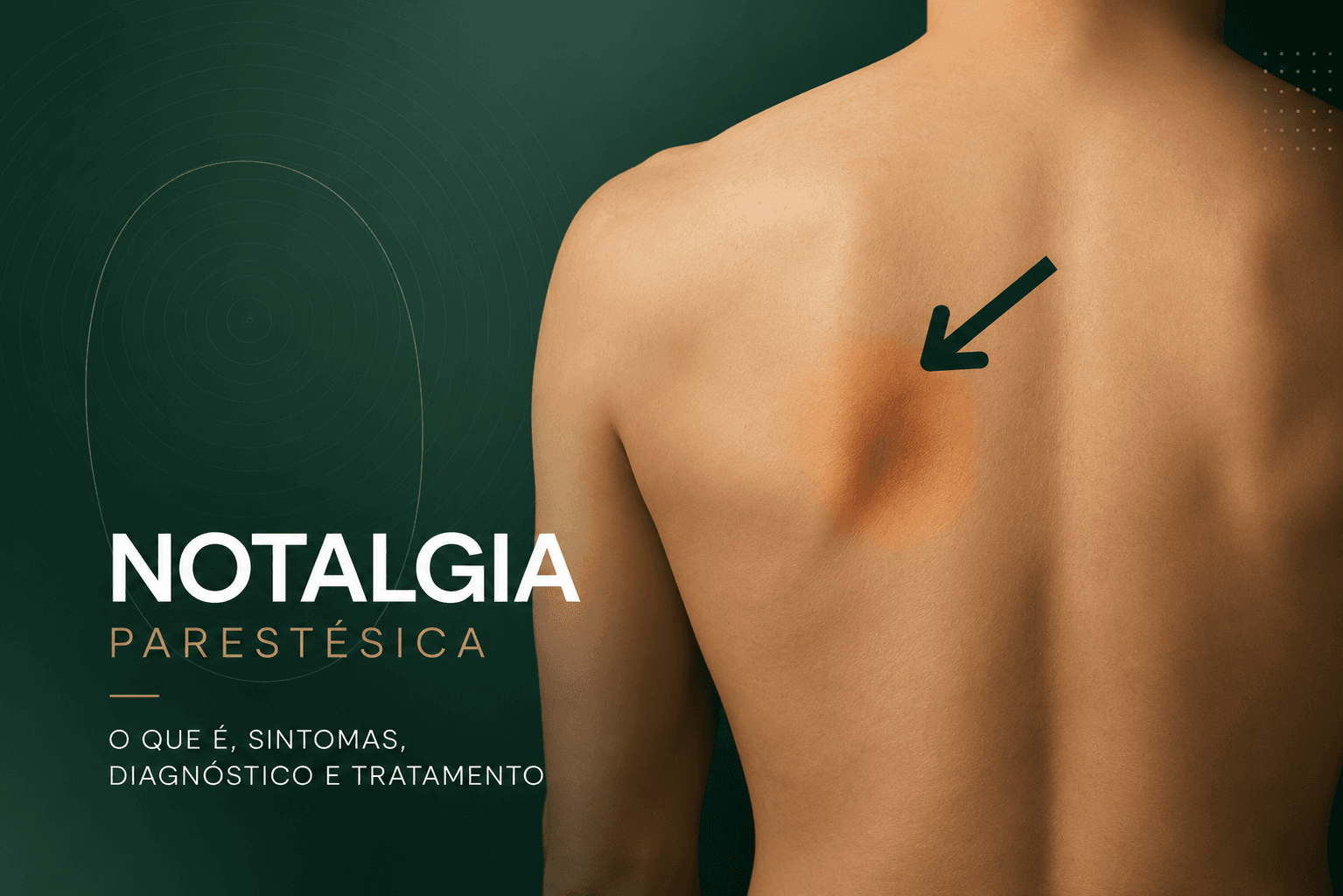 Notalgia parestésica com destaque para a região entre a coluna e a escápula